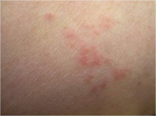 Photo of a person's arm with bed bug bites