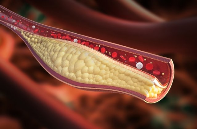 graphic of a plaque buildup in an artery