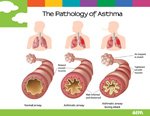 air poster - asthma diagram