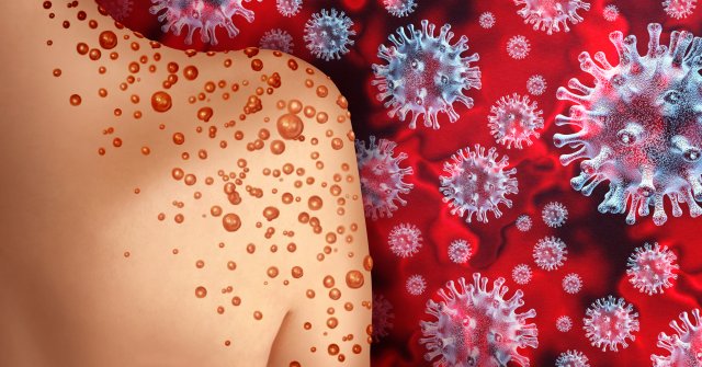 Illustration of monkeypox virus on a human shoulder.